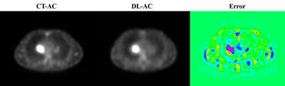 Direct attenuation correction for 99mTc-3PRGD2 chest SPECT lung cancer images using deep learning